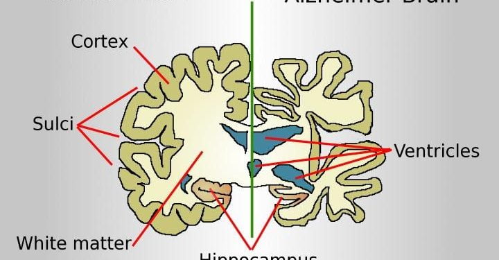 Alzheimer_wikimedia_commons_2017