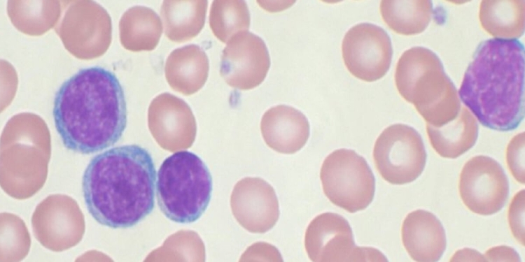 Leucemia linfatica cronica (Wikipedia)