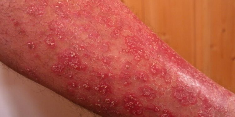 Psoriasi, crema miracolosa ma illegale