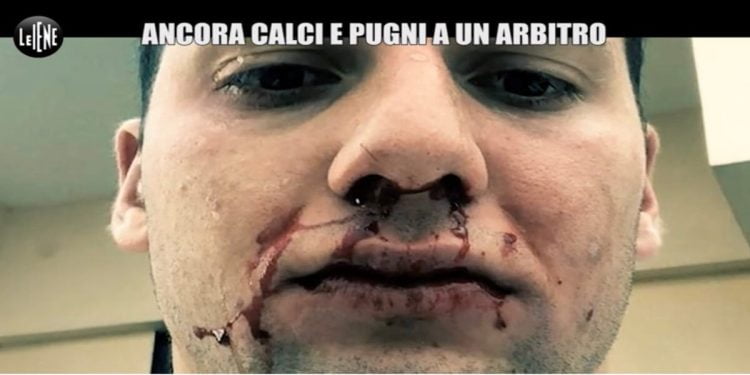 Cardito, arbitro aggredito con calci e pugni