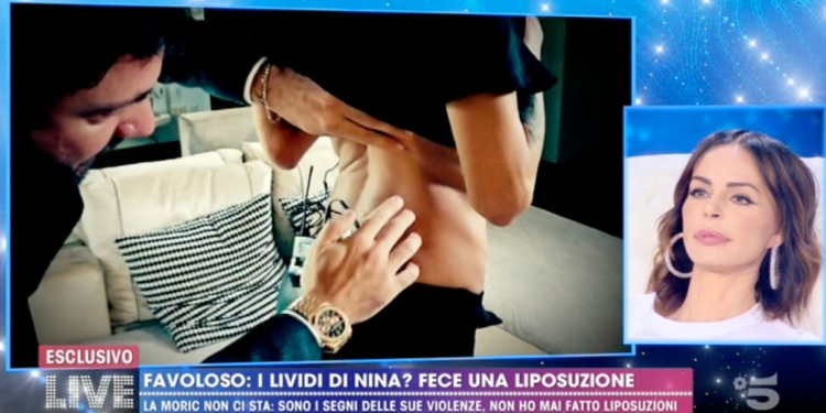 Nina Moric, lividi da violenze o liposuzione? (Live Non è la D'Urso)