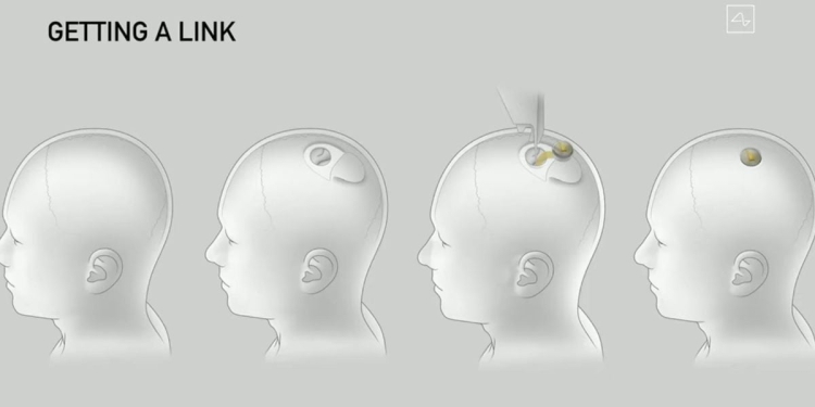 Neuralink Elon Musk: microchip