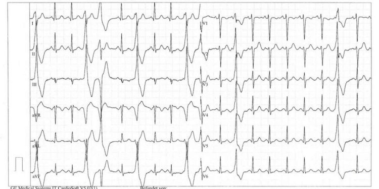 Elettrocardiogramma che mostra aritmie cardiache