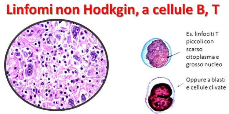 Alcuni esempi cellulari di linfomi non-Hodgkin