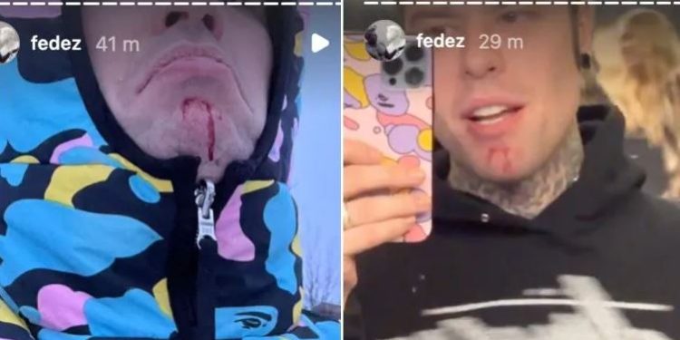 Fedez,, incidente sulle nevi (Instagram)