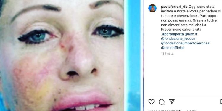 Paola Ferrari mostra il tumore alla pelle (Instagram)