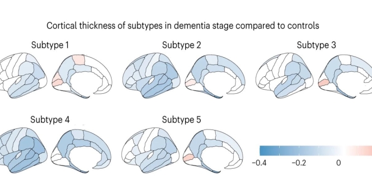 Atrofia corticale associata ai sottotipi di AD in fase di demenza rispetto ai controlli (da Nature Aging)