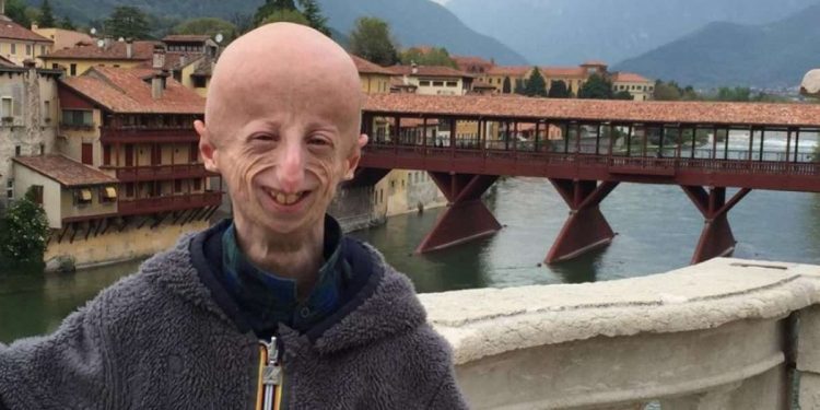 Sammy Basso, cos'è la Progeria